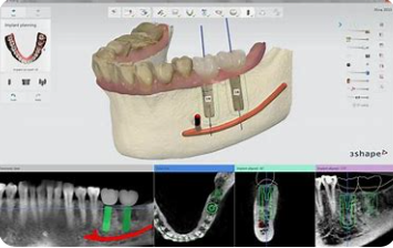 Implant Restoration